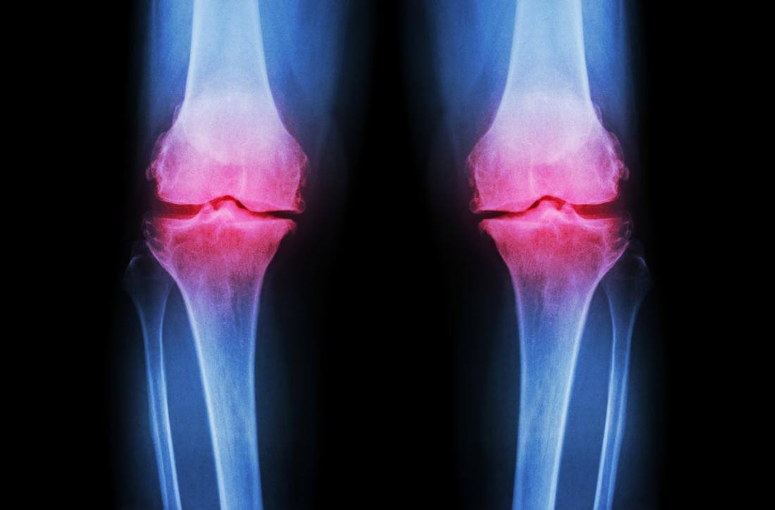 Ayurvedic Treatment of Osteoarthritis