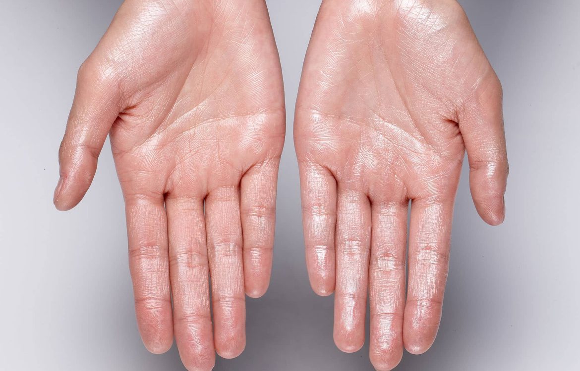 Hyperhidrosis