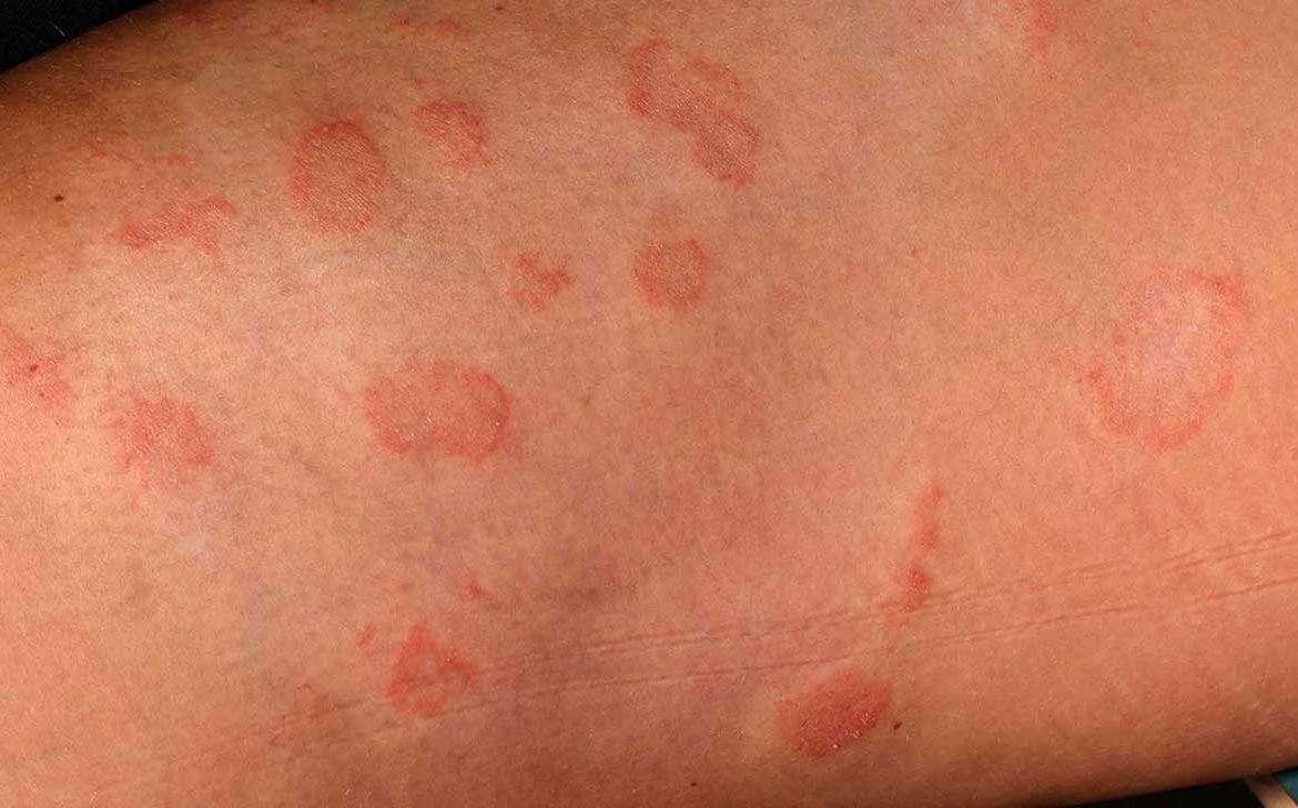 Fungal Infection, Symptoms, Causes and Ayurvedic Treatment