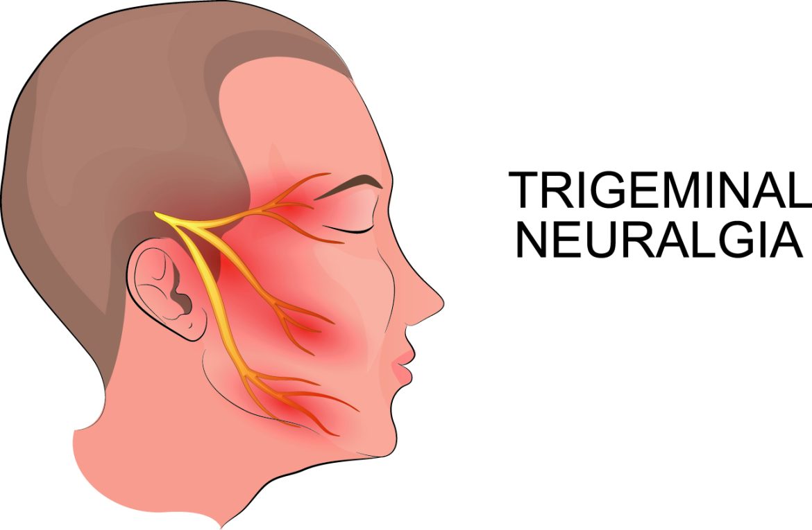 Trigeminal-neuralgia-
