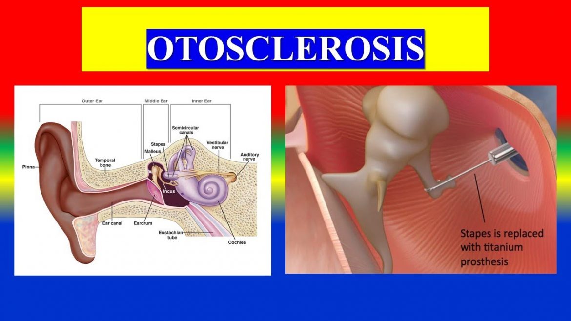 otosclerosis