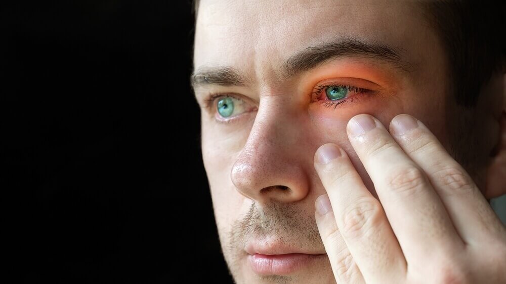 Blepharitis