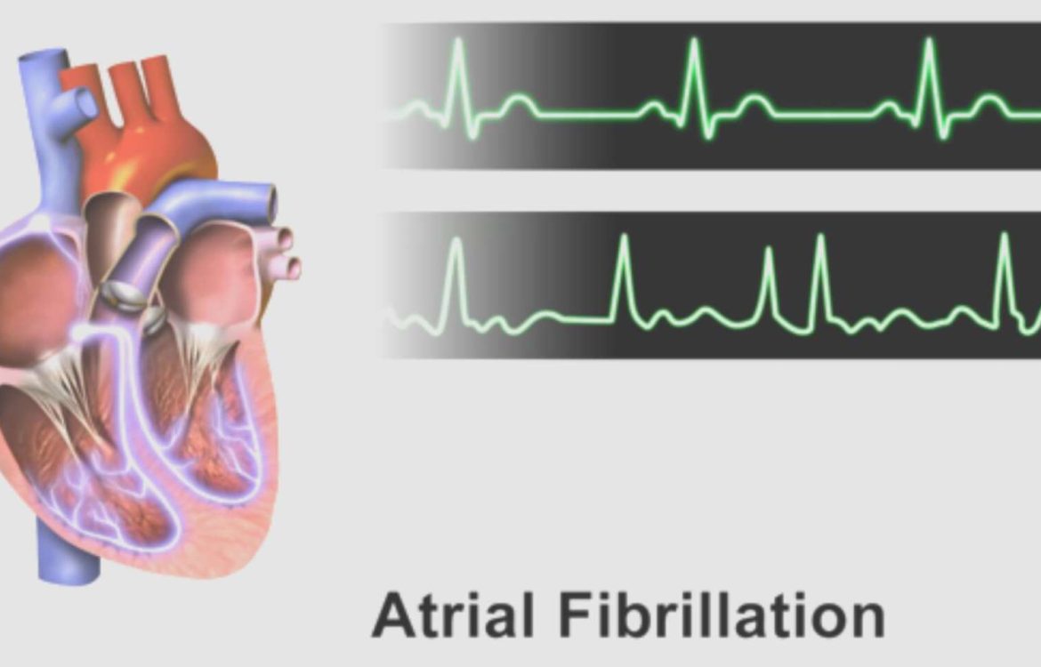 atrial-fibrillation